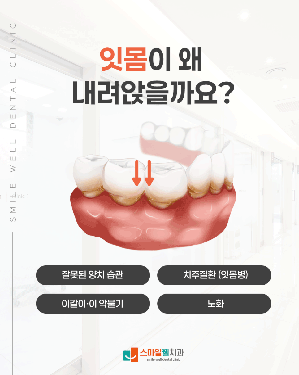 잇몸 내려앉음 원인, 치아가 길어 보인다면 확인하세요