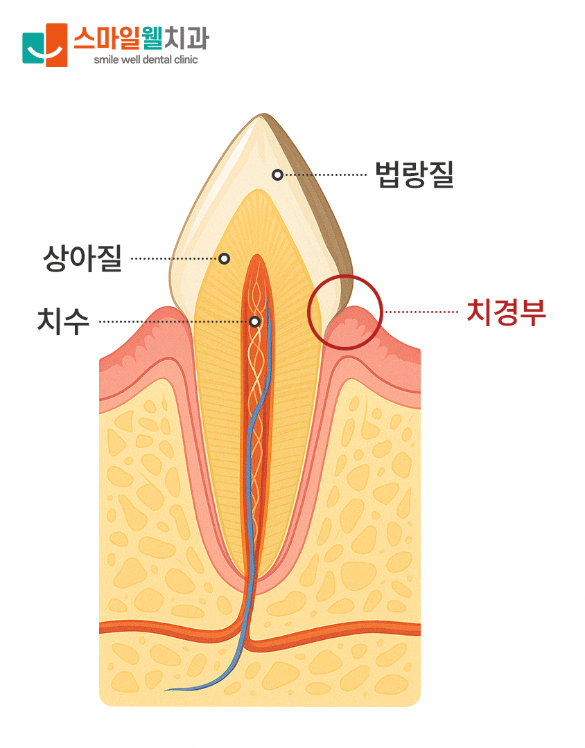 치경부 마모증, 찬물 마실 때 찌릿하다면? 원인과 치료법 정리