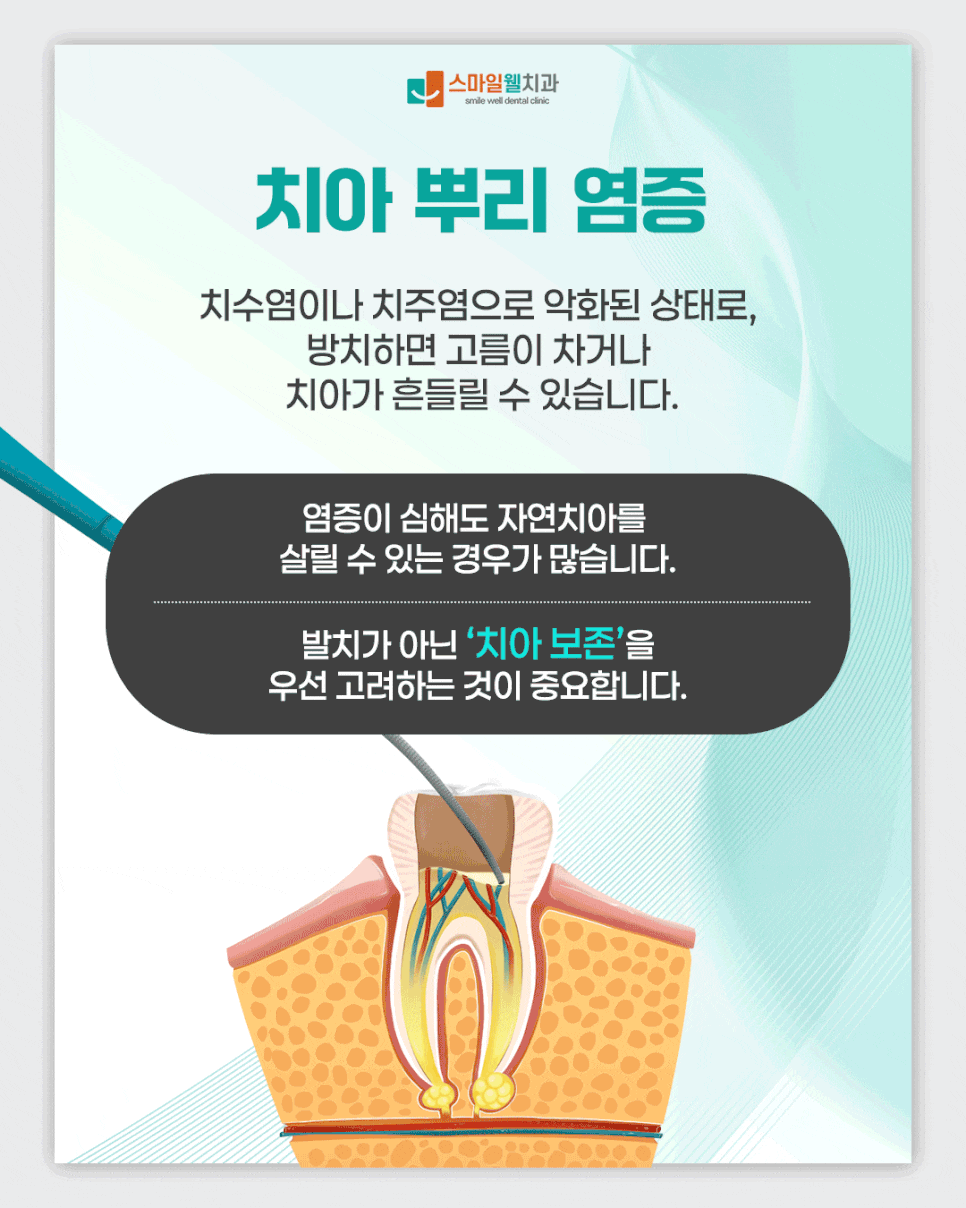치아 뿌리 염증, 무조건 발치해야 하나요? 보존 방법 정리
