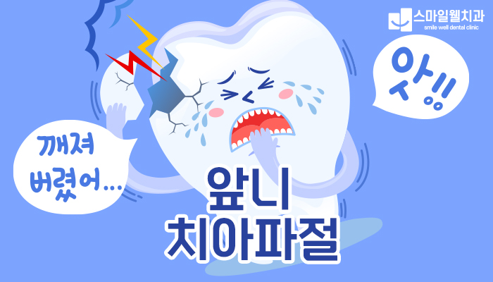 앞니 치아파절, 임플란트 대신 자연치 살리는 방법은?