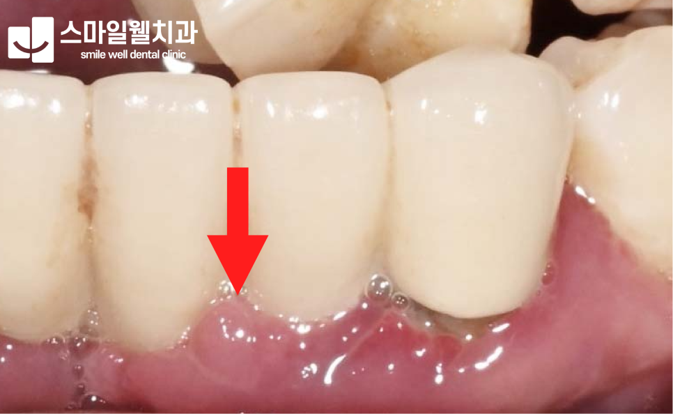 잇몸이 붓고 피가 난다면? 치주질환 의심 증상과 관리법