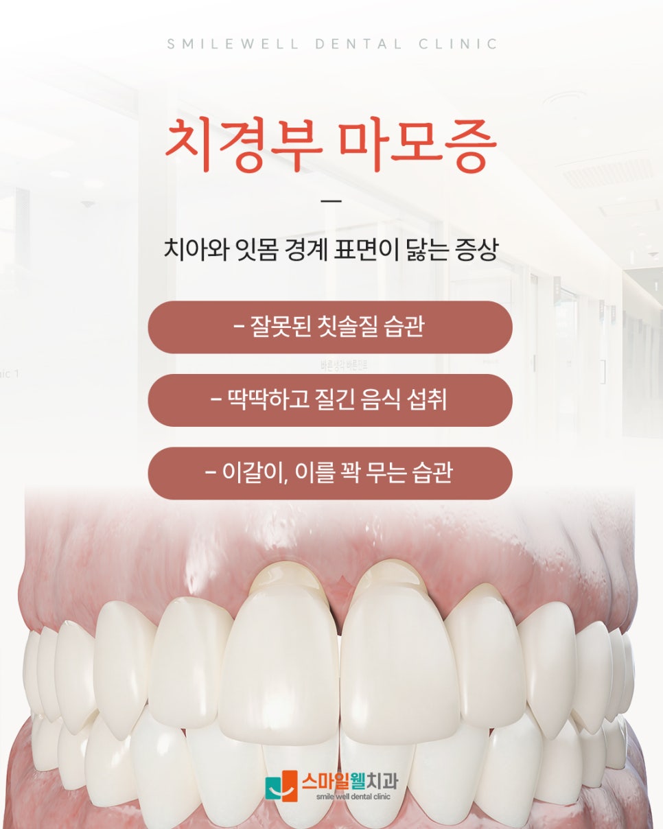 치경부 마모증, 시린 증상 원인과 치료 방법은?