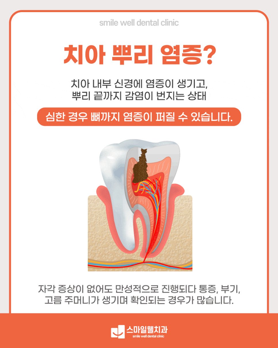 치아 뿌리 염증 원인과 치료법, 자연치아 살릴 수 있을까?