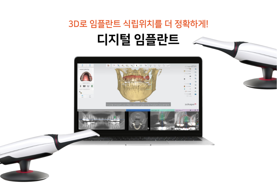3D로 임플란트 식립위치를 더 정확하게 — 노트북 3D 임플란트 플래닝 화면과 디지털 구강 스캐너