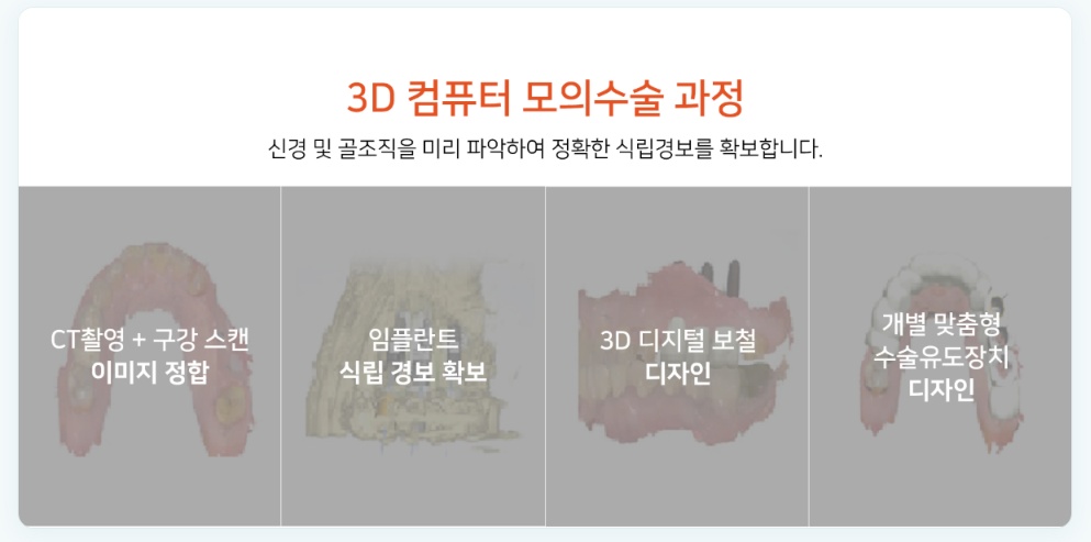 3D 컴퓨터 모의수술 과정 — CT촬영+구강스캔 이미지 정합, 임플란트 식립 경로 확보, 3D 디지털 보철 디자인, 개별 맞춤형 수술유도장치 디자인